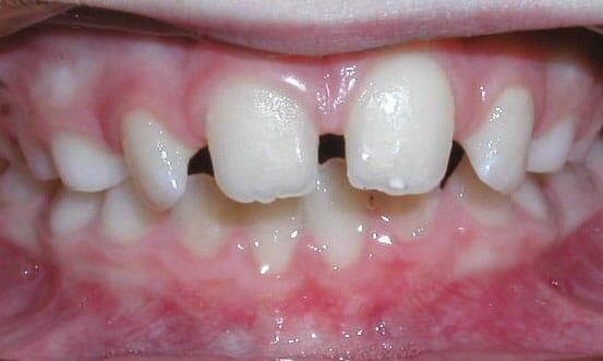 Spacing Bite Problem Coastal Smiles Family Orthodontics in Naples, FL