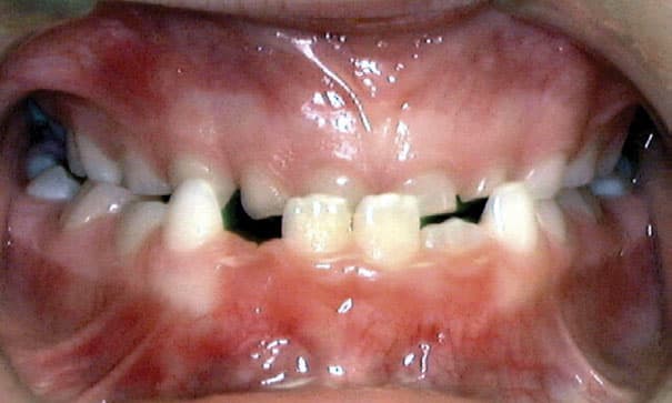 Underbite Problem Coastal Smiles Family Orthodontics in Naples, FL