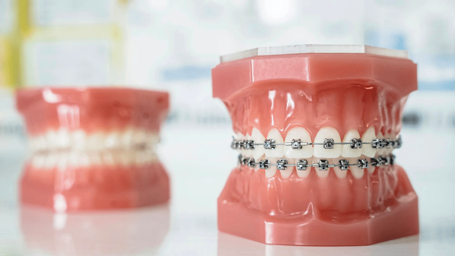 Types of Braces Coastal Smiles Family Orthodontics in Naples, FL