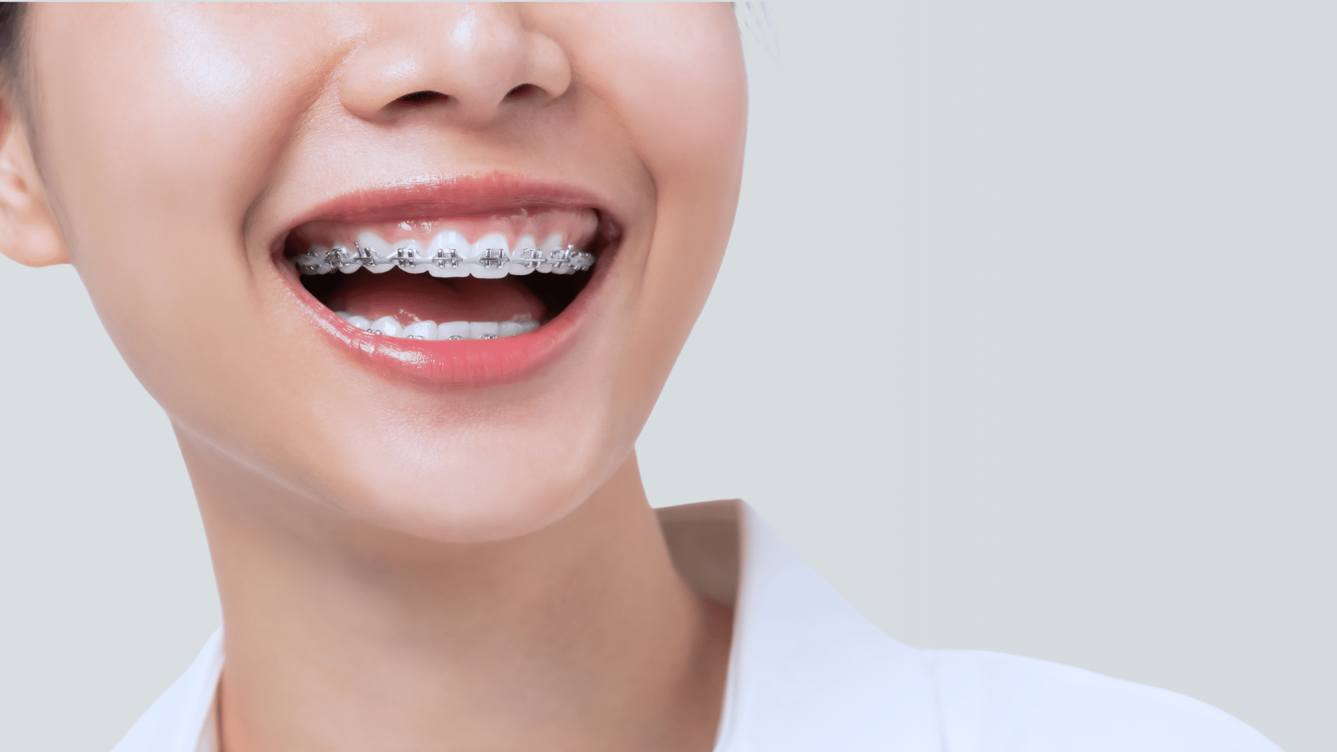 Types of Braces Coastal Smiles Family Orthodontics in Naples, FL