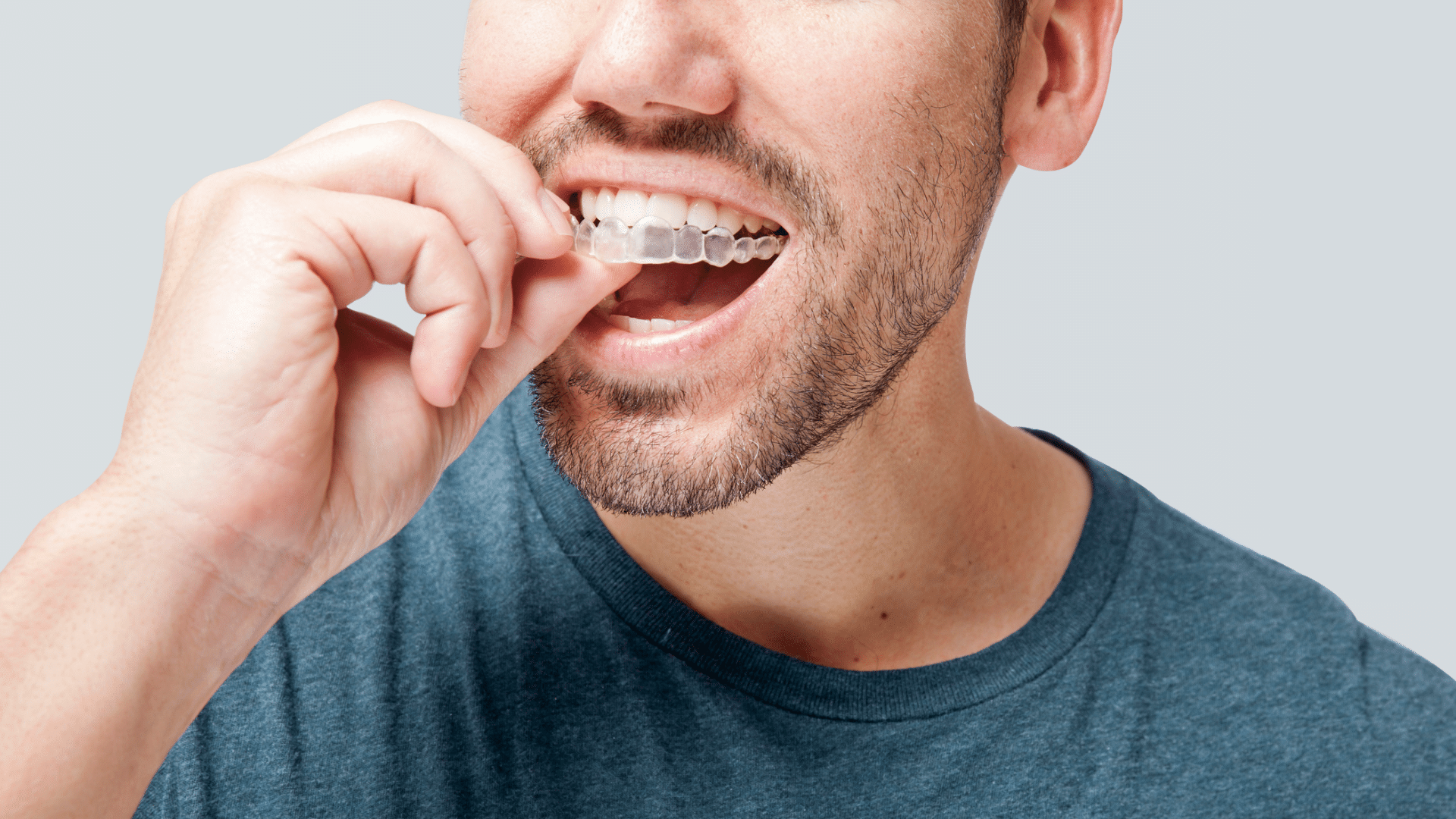 Invisalign Clear Aligners Coastal Smiles Family Orthodontics in Naples, FL